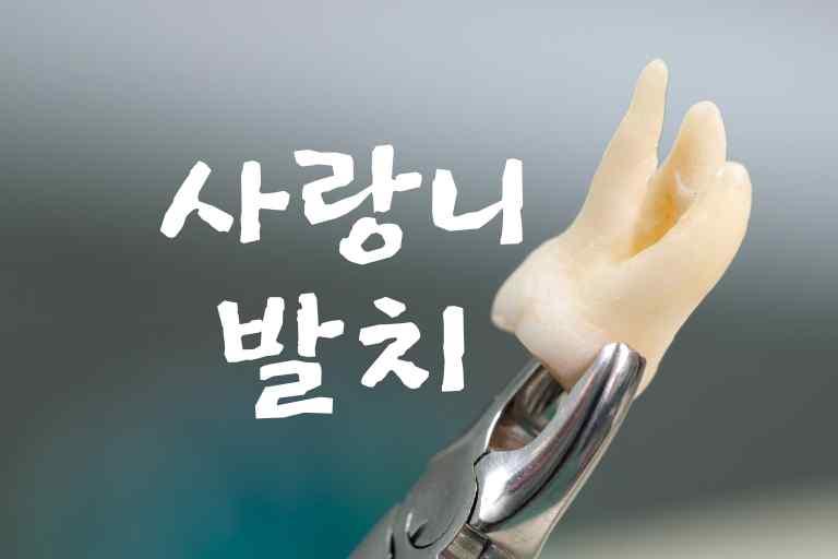 사랑니 발치 후 회복 기간과 주의사항 6